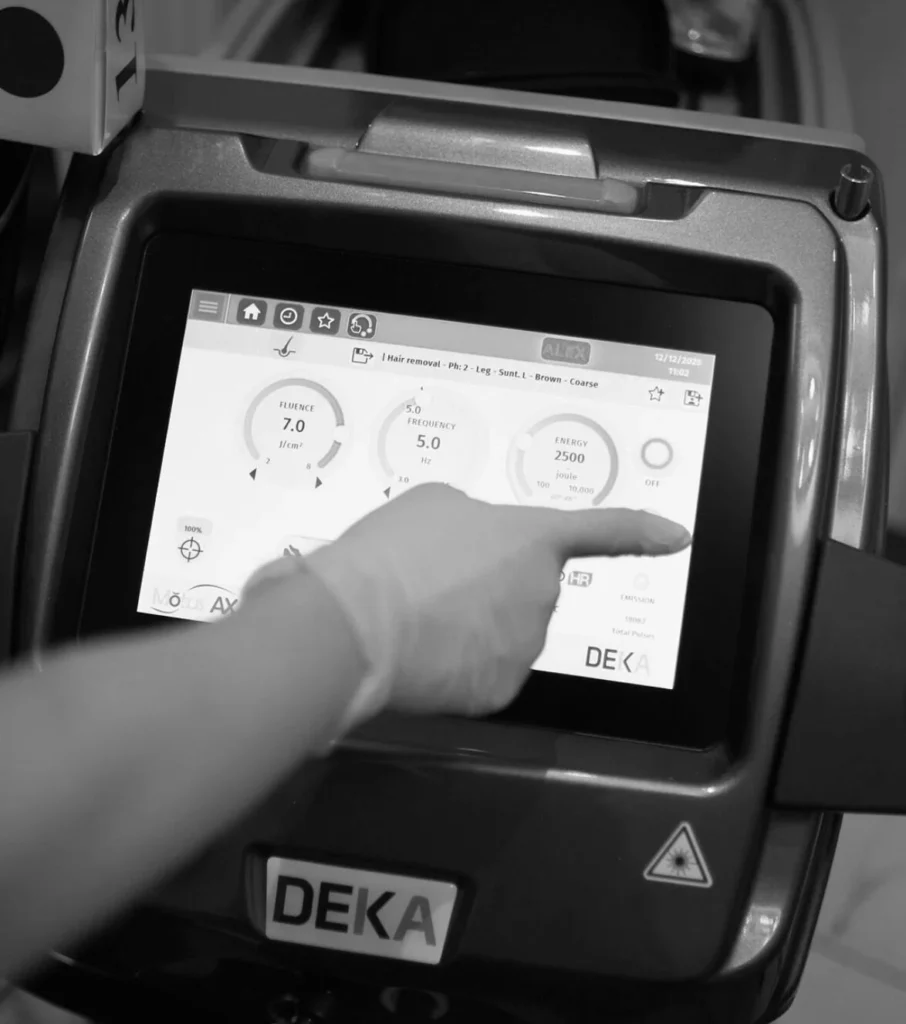 Laser-Haarentfernung DEKA bei der Dyvo