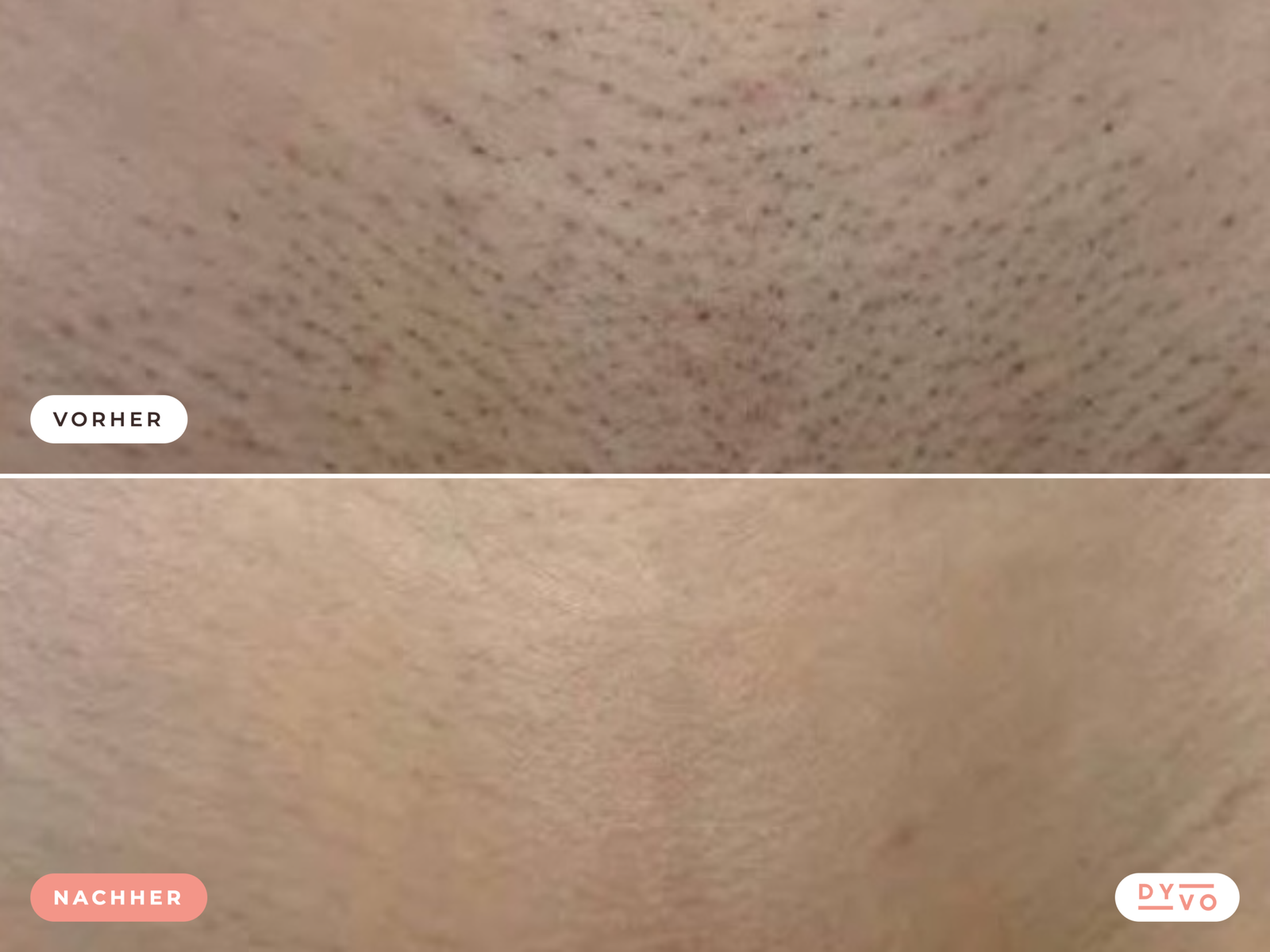 Laser-Haarentfernung im Intimbereich, Kosten und Ablauf im Überblick